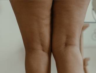 Kan je wat doen tegen cellulite? Dermatoloog: “Er zijn 4 fases die elk een andere oplossing vragen”
