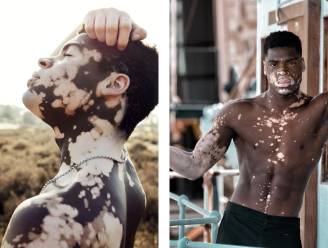 Love Islander Gideon openhartig over zijn huidaandoening: “Het leven begon pas nadat ik vitiligo kreeg”