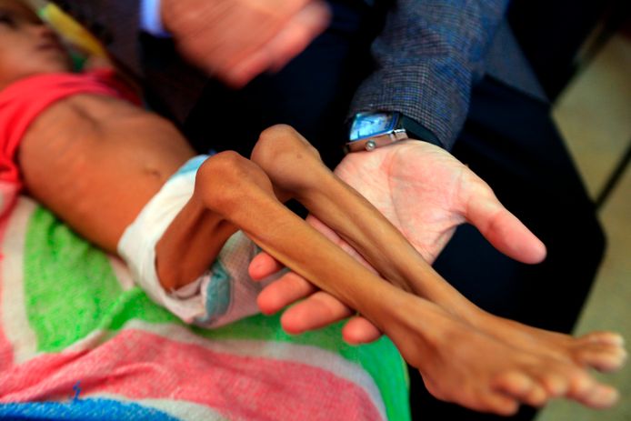 Een ondervoed kindje in een ziekenhuis in Sanaa, de hoofdstad van Jemen (foto gemaakt op 6 oktober)