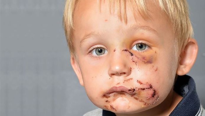 Door Hitte Bevangen Pitbull Grijpt Britse Kleuter Buitenland Ad Nl