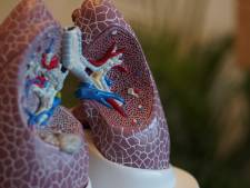 Première mondiale en Belgique: des stents placés dans les artères pulmonaires