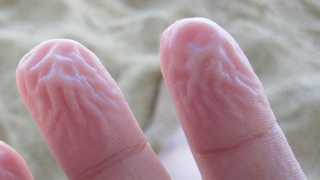 Vingertop verwijd na 30 weken