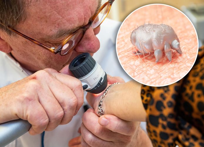 De Deventer dermatoloog Ronald Houwing speurt bij een patiënt naar de schurftmijt. Inzet: het gewraakte beestje.