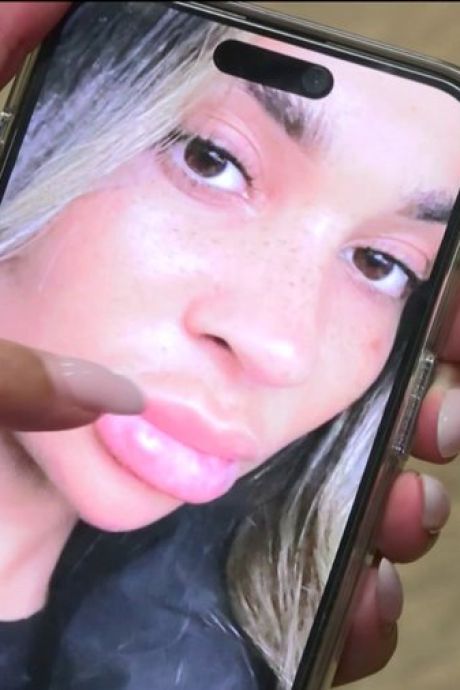 Victime d’injections clandestines ratées, elle raconte: “Ma lèvre allait exploser”