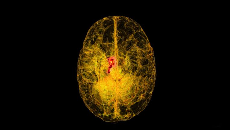 MRI-scan van de hersenen van een verliefde tiener Beeld HH