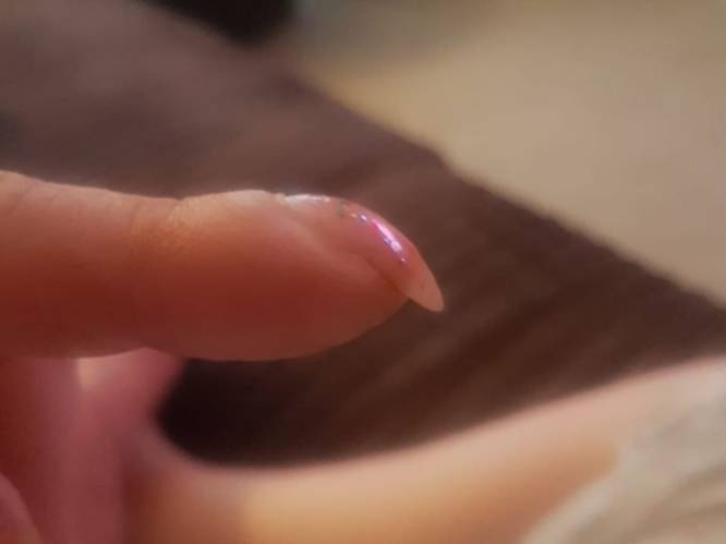 Foto van haar gebogen vingernagel op Facebook redt Britse vrouw het leven