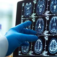 ‘Zonder extra investeringen missen we een unieke kans’: alzheimeronderzoek in België en VS bedreigd