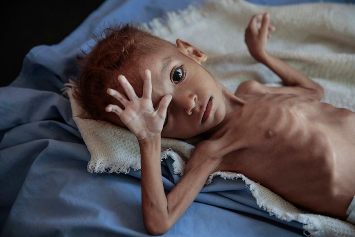 Volgens de VN dreigen 12 tot 13 miljoen mensen te verhongeren in Jemen - een land met ongeveer 28 miljoen inwoners. Naar schatting 1,8 miljoen kinderen lijden honger.