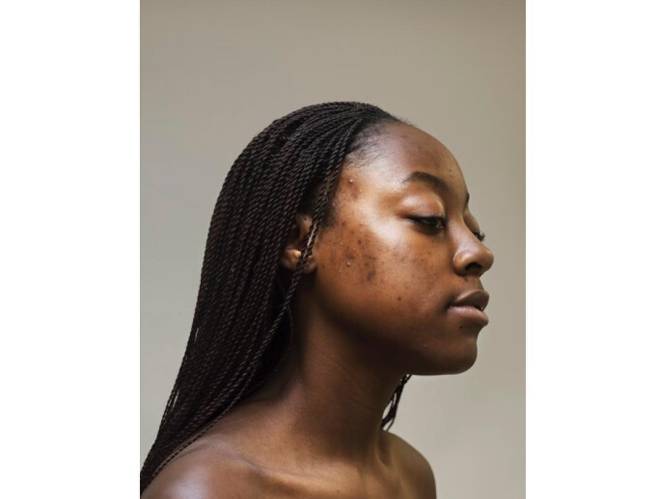 Fotoreeks toont vrouwen zonder make-up: acne mag geen taboe zijn
