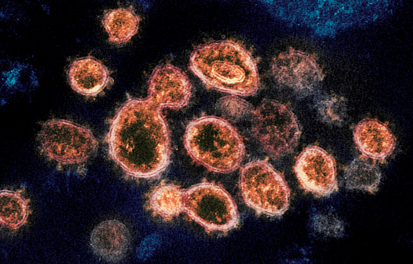 SARS-CoV-2 virus-deeltjes die Covid-19 veroorzaken.