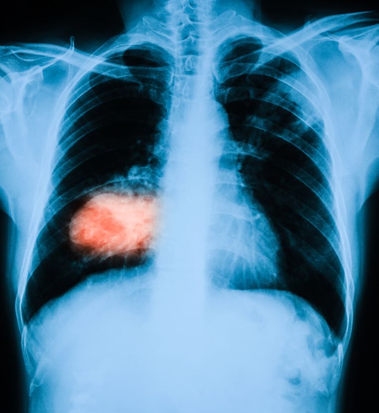 Röntgenfoto van de longen, met links in het rood een longtumor. Beeld Getty Images