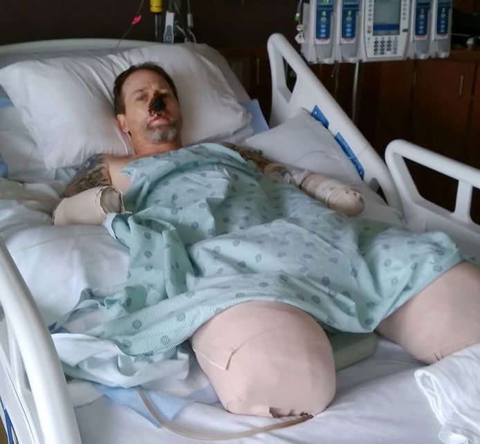 Man Verliest Handen En Benen Door Hondenspeeksel Wetenschappers Vinden Genetische Oorzaak Medisch Hln Be