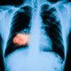 Screening op longkanker bij (ex-)rokers zou ‘duizenden doden voorkomen’, maar deskundigen zijn sceptisch