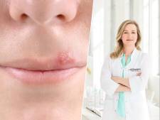 Herpes op je lip! Dit kun je eraan doen en zo voorkom je zo'n nare koortslip
