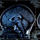 Nieuw medicijn remt Alzheimer volgens onderzoekers significant af