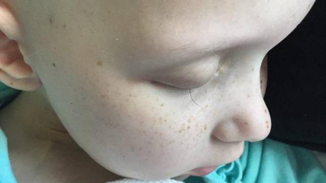 Papa deelt hartbrekende foto van dochtertje dat nog maar 1 wimper overhoudt na chemo