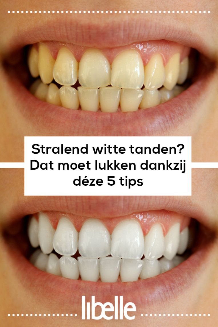 uitslag ijs Spookachtig Stralend witte tanden? Dat moet lukken dankzij déze 5 tips | Libelle