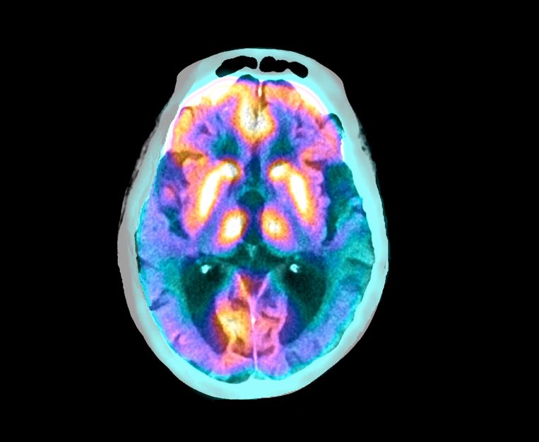 Hersenscan waarop ziekte van Alzheimer zichtbaar is. 
 Beeld Science Photo Library