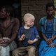 In verkiezingstijd worden albino’s in Malawi vermoord voor geluksdrank