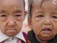 Ces deux enfants souffrent du "syndrome de Benjamin Button"