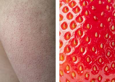 4 op de 10 Belgen heeft keratosis pilaris of ‘strawberry skin’. Dermatoloog geeft tips tegen de kleine, rode bultjes