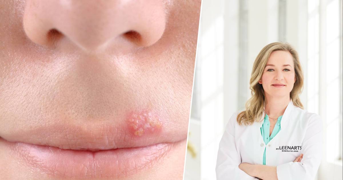Herpes on Your Lip How to Treat and Prevent Cold Sores Hello Maco