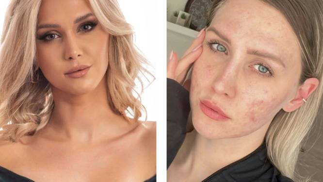 Ondanks haar zware acne wint Lore (27) missverkiezing. “Ik wil mijn aandoening bespreekbaar maken”