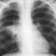 Aantal gevallen van tbc lichtjes gedaald in België