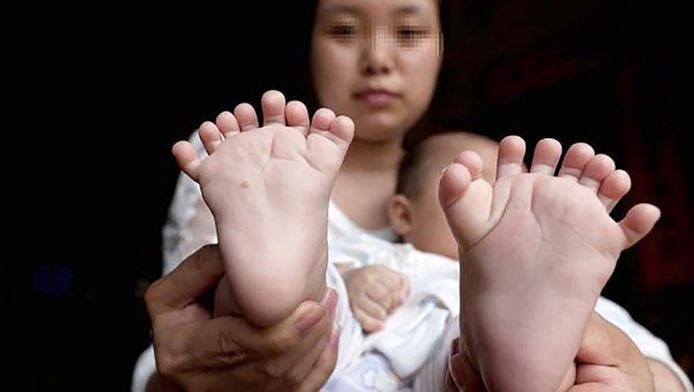 Woordenlijst ontvangen Mooie vrouw Baby met 15 vingers en 16 tenen geboren in China | Buitenland | AD.nl