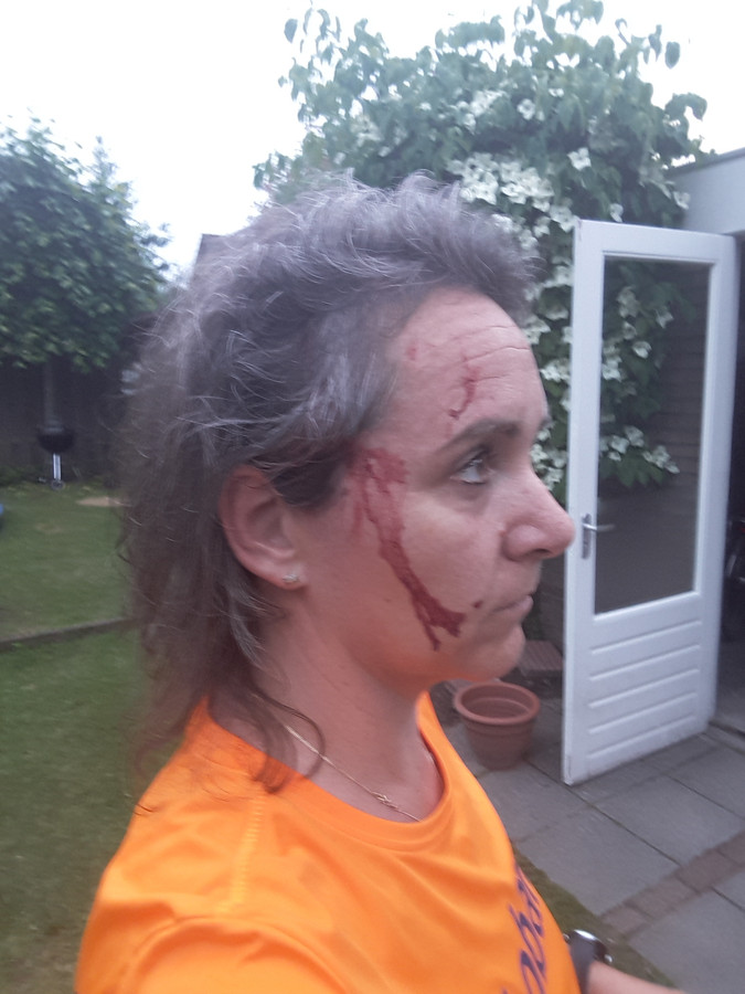 Suzanne van Vugt is aangevallen door een roofvogel in Heukelom. Hij doorboorde haar hoofd met zijn klauwen.