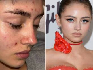 Ook last van acne zoals de dochter van Heidi Klum? Dermatoloog: “Dit is dé grote boosdoener”
