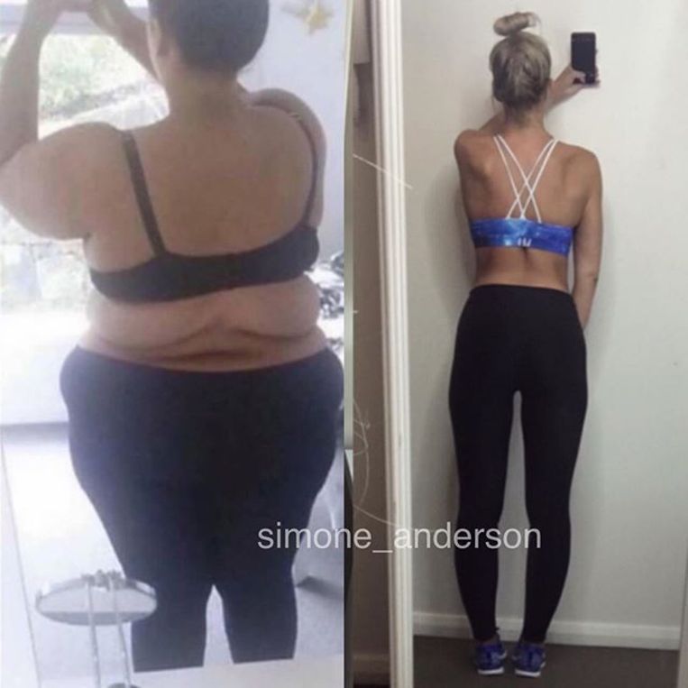 Instagramster valt 92 kg af, laat overtollige huid