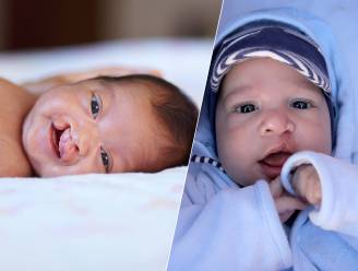 300 baby’s per jaar worden geboren met schisis: ‘Sommige patiënten blijven een afwijkende spraak houden’
