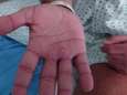 La variole du singe diagnostiquée pour la première fois chez des enfants aux États-Unis