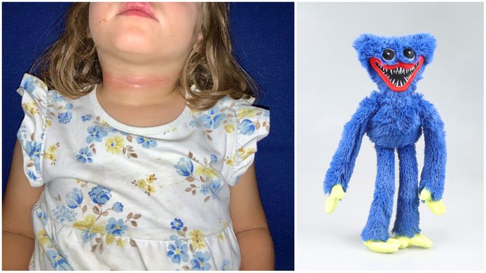 Lisa, 3 ans, a échappé au pire après avoir été étranglée par un petit  garçon avec une peluche “Huggy Wuggy”, Faits divers