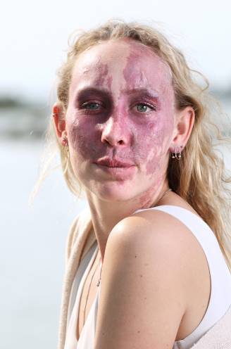 Tessa (29) vertelt over leven met een opvallend uiterlijk: “Ik probeerde het te camoufleren met make-up maar herkende mezelf niet meer”
