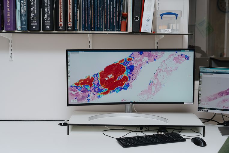 Een scan van een borsttumor. De kleurschakeringen zijn het werk van de AI-software. Beeld Wouter Van Vooren