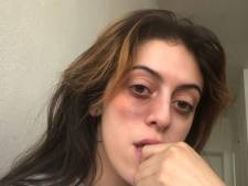 Frappée devant chez elle par un inconnu, Clara affiche son visage tuméfié sur Twitter: “Éduquez vos fils”
