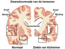 Gezonde hersenen en aangetaste hersenen die tot dementie leiden.