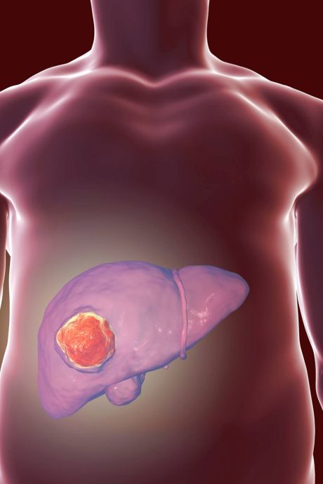 De plus en plus de cancers du foie détectés en Belgique: “La chimiothérapie n’aide pas à combattre cette maladie”