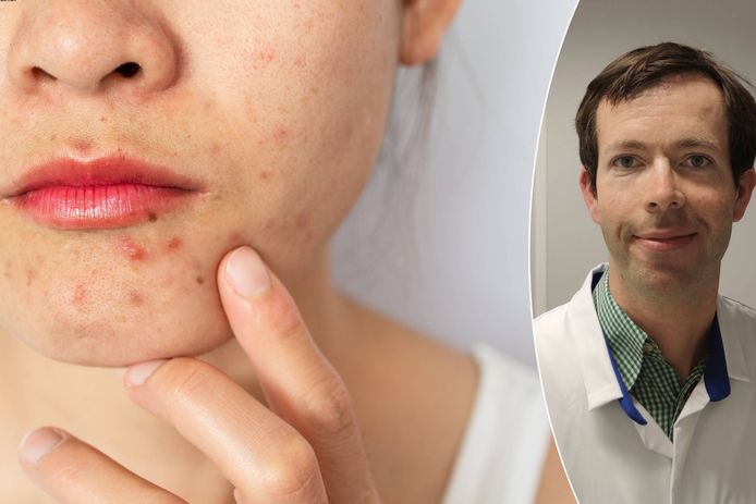 Dermatoloog Reinhart Speeckaert zet de verschillende soorten acne op een rij.