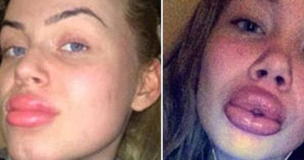 Faire Gonfler Ses Levres Seule A La Maison Est Ultra Dangereux Sante Bien Etre 7sur7 Be