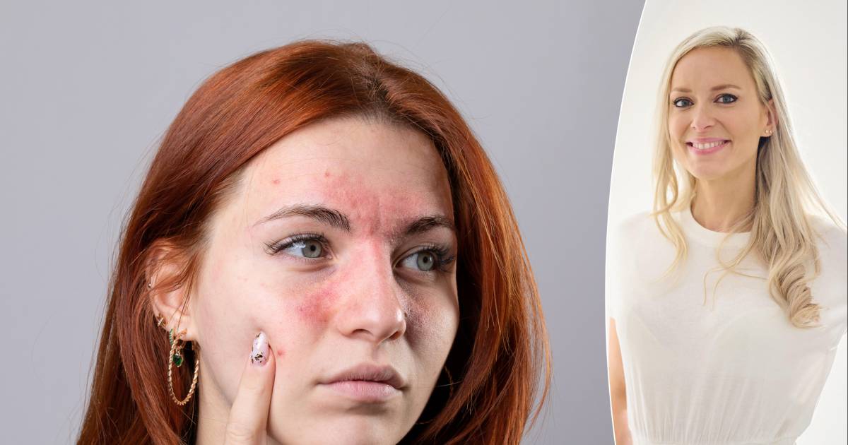 Un visage rouge avec des vaisseaux sanguins bien visibles : que faire ...