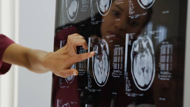 Wetenschappers ontdekken dat brein van ex-coronapatiënten is gekrompen