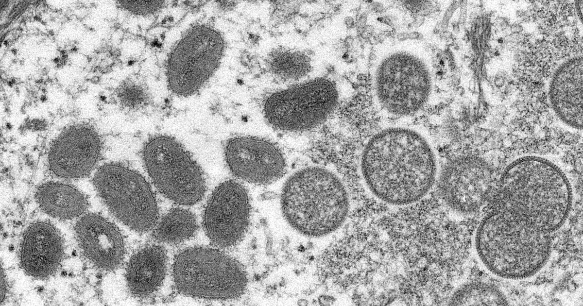 Primi casi di virus del vaiolo delle scimmie in Svizzera e Israele, anche la Norvegia avvia le indagini su un possibile focolaio |  vaiolo delle scimmie