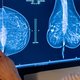 Borstkankeroperatie niet langer overal terugbetaald: kijk hier welke ziekenhuizen erkend zijn
