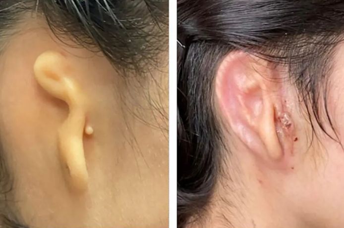 Het oor van de vrouw voor en na de operatie.