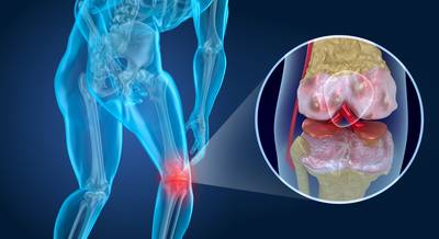 Gescheurde meniscus: wanneer is een operatie nodig? En welke alternatieve oplossingen zijn er?