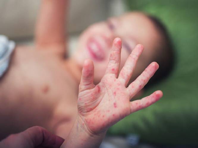 Mazelenepidemie in Italië: verplichte vaccinaties voor kinderen en jongeren