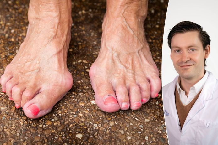 Dokter Arne Burssens, orthopedisch chirurg voet- en enkelheelkunde in UZ Gent, vertelt wat je aan hamertenen kan doen.